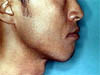 下顎前突(外科矯正治療を伴ったもの)